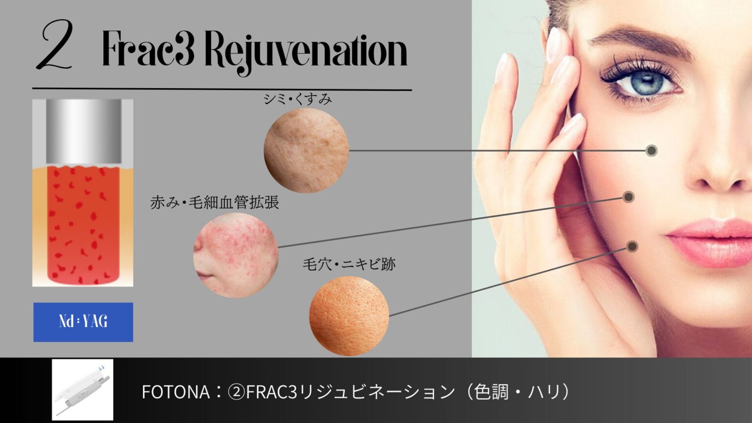 FOTONA②FRAC3リジュビネーションの3次元フラクショナル照射図解。ハリ・色調・くすみ改善を担うモード