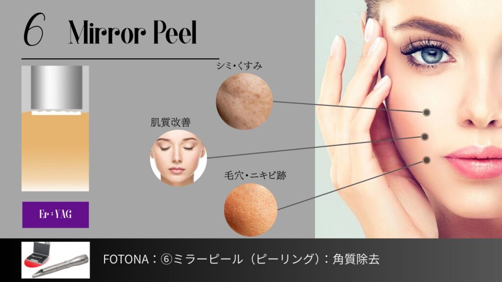 名古屋駅（名駅）の美容皮膚科・形成外科ベルヴィアクリニックによる、FOTONA SP Dynamisを用いたレーザーピーリング「ミラーピール」の解説画像。エルビウムヤグレーザー（Er:YAG）を照射し、角質を除去することでシミ・くすみ、肌質改善、毛穴・ニキビ跡にアプローチする仕組みを、専門医の視点から可視化した図解。
