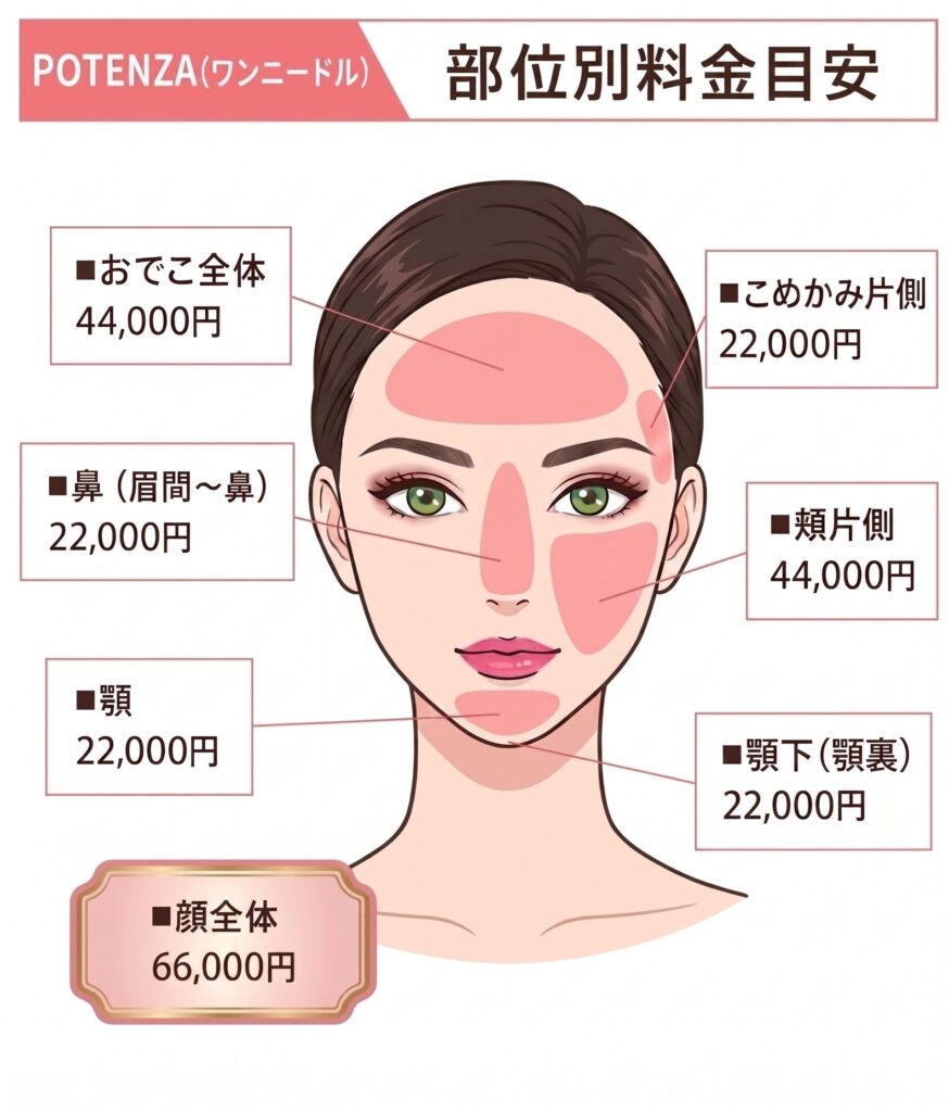 名古屋駅（名駅）からすぐの美容皮膚科・形成外科、ベルヴィアクリニックによるポテンツァ（POTENZA）ワンニードルを用いた炎症性ニキビの根本治療。おでこ、鼻、頬、顎下など、顔の各部位における治療費用の目安を示した料金表イラスト。