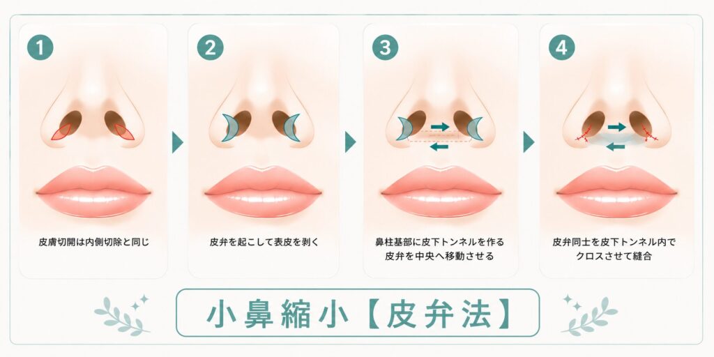 名古屋駅（名駅）の形成外科・美容皮膚科「Belle Via Clinic（ベルヴィアクリニック）」による小鼻縮小術（皮弁法・フラップ法）の4ステップ手技解説イラスト。1は内側切除と同位置の鼻孔底皮膚切開、2は皮弁作成と表皮剥離、3は鼻柱基部への皮下トンネル作成と中央への移動、4は皮弁同士を皮下でクロスさせ縫合固定する流れを矢印で表現。皮脂分泌と筋肉の張力を抑えて傷跡を極限まで美しく治すボトックス治療を併用した鼻整形のシミュレーション図。