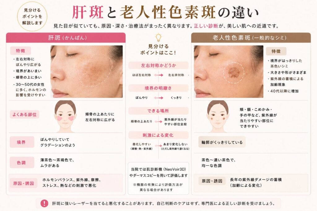 名古屋駅(名駅)エリアの美容皮膚科・形成外科における、肝斑と老人性色素斑(一般的なシミ)の違いを比較・解説する画像。女性の頬の症例写真と顔のイラストを用い、左右対称性、境界の明瞭さ、好発部位、刺激による変化という4つの見分けるポイントを図解しています。肌診断機NeoVoir3Dを用いた評価や、肝斑への不適切なレーザー照射に対する注意喚起も記載されています。
