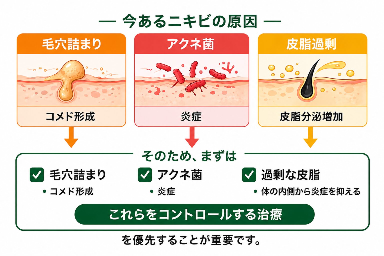 ニキビの3つの原因(毛穴詰まり・アクネ菌・皮脂過剰) ニキビの原因を示した図解。毛穴詰まりによるコメド形成、アクネ菌による炎症、皮脂過剰による皮脂分泌増加の3つが主な原因であり、これらをコントロールする治療が重要であることを説明している
