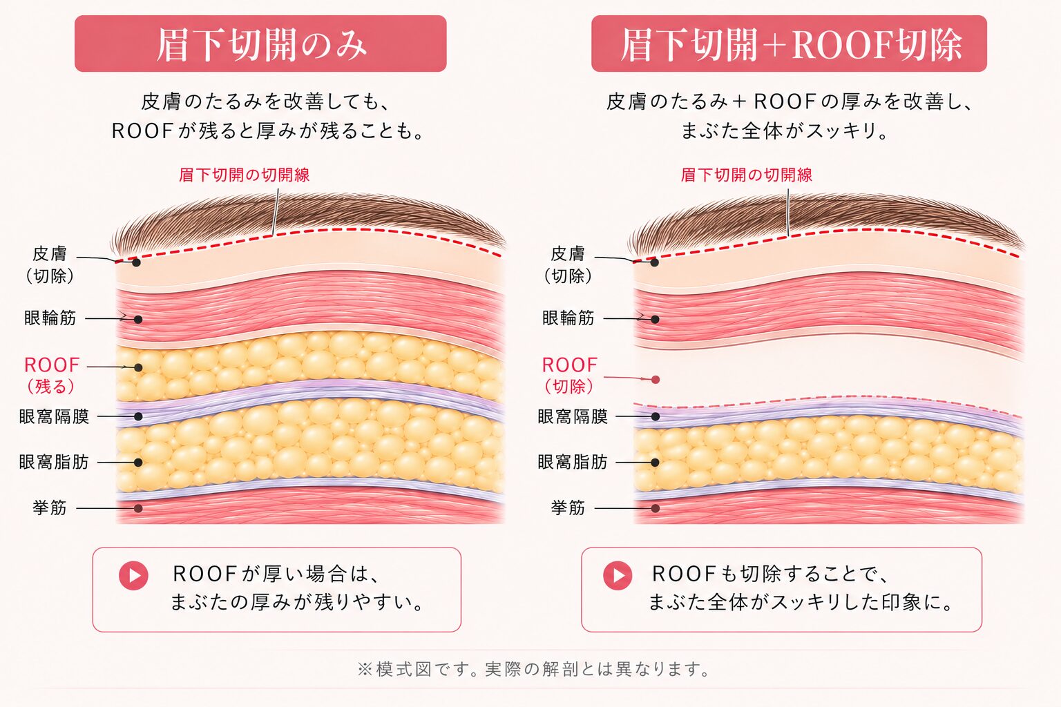 ROOF切除術 眉下脂肪の位置と切除範囲の解説 ベルヴィアクリニック名古屋