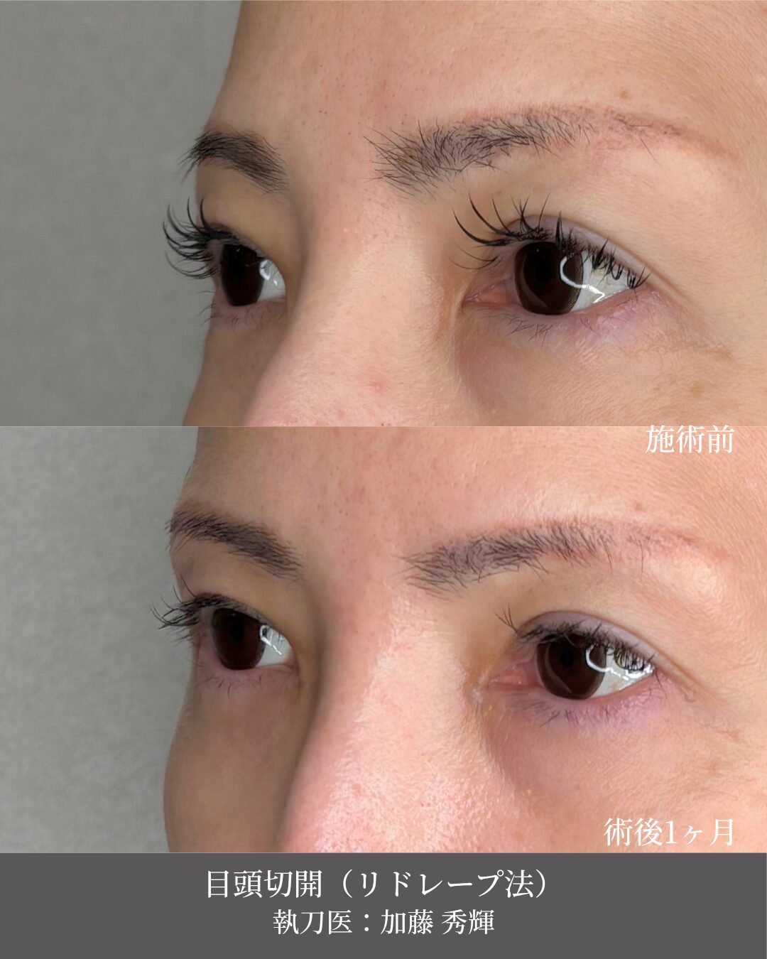 目頭切開（リドレープ法）施術前後 別角度 術後1ヶ月 執刀医：加藤秀輝 ベルヴィアクリニック名古屋