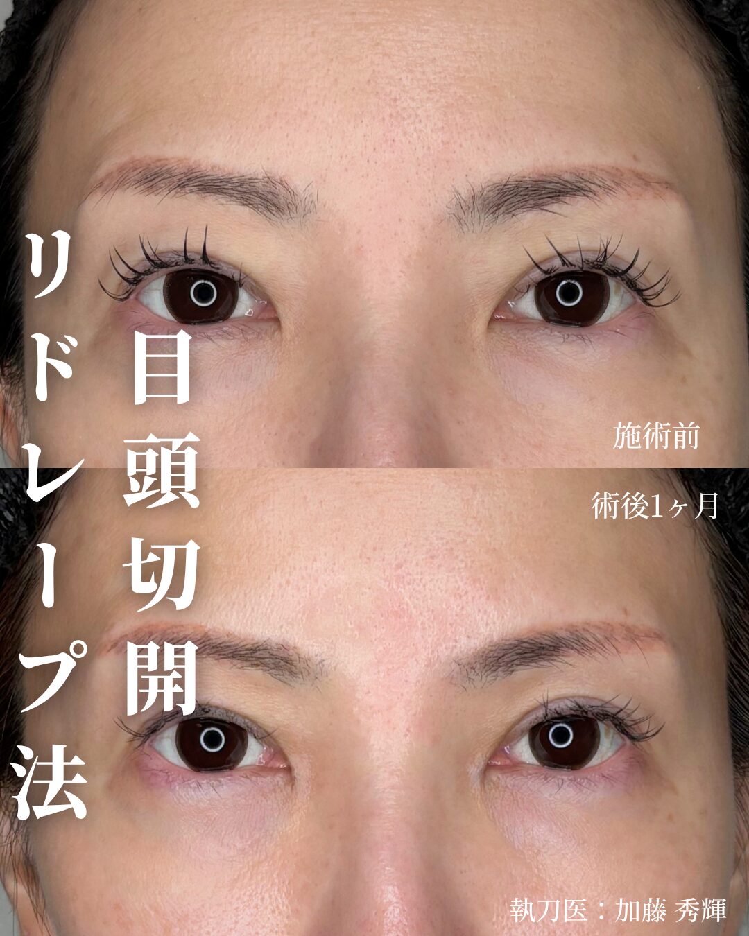 目頭切開（リドレープ法）施術前後 正面 術後1ヶ月 執刀医：加藤秀輝 ベルヴィアクリニック名古屋