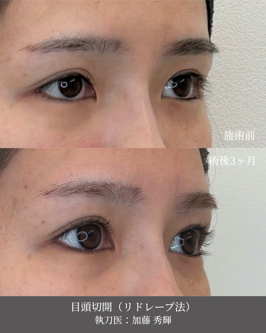 目頭切開（リドレープ法）施術前後 別角度 術後3ヶ月 執刀医：加藤秀輝 ベルヴィアクリニック名古屋
