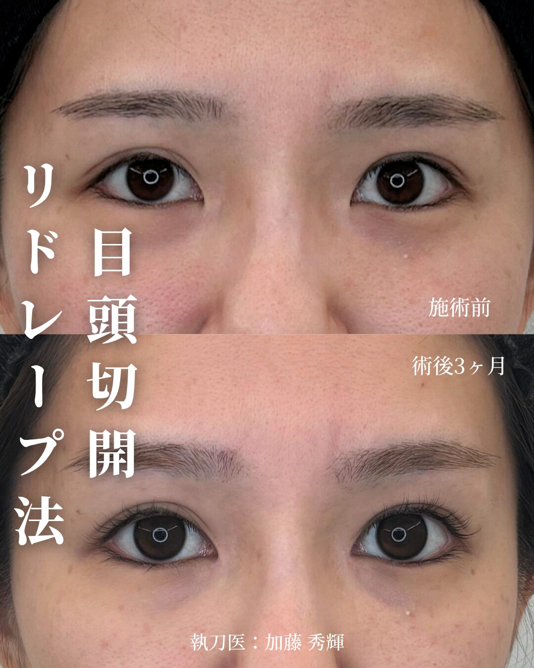 目頭切開（リドレープ法）施術前後 正面 術後3ヶ月 執刀医：加藤秀輝 ベルヴィアクリニック名古屋