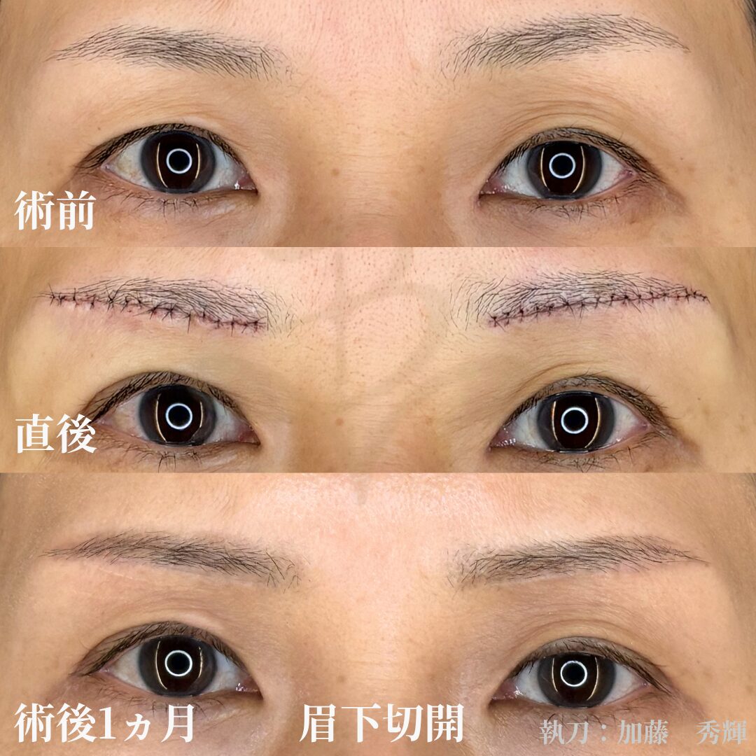 眉下切開 1ヶ月後の経過写真 術前後比較 ベルヴィアクリニック名古屋