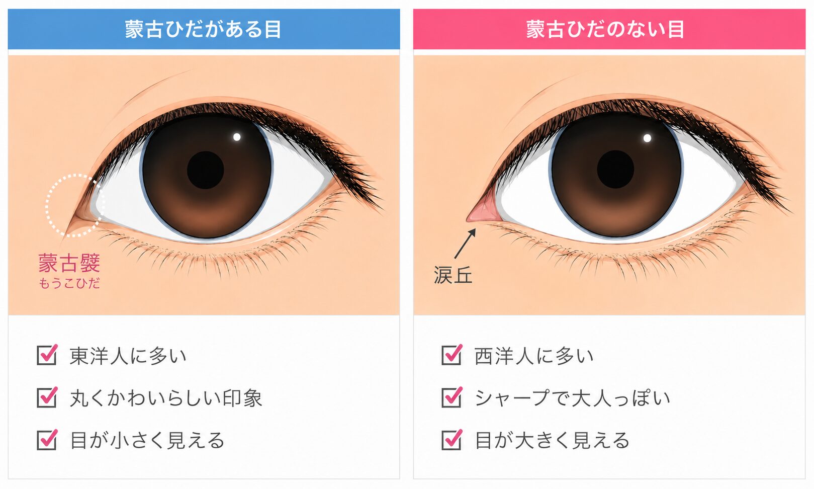 蒙古襞がある目とない目の比較イラスト｜涙丘の見え方の違い ベルヴィアクリニック名古屋
