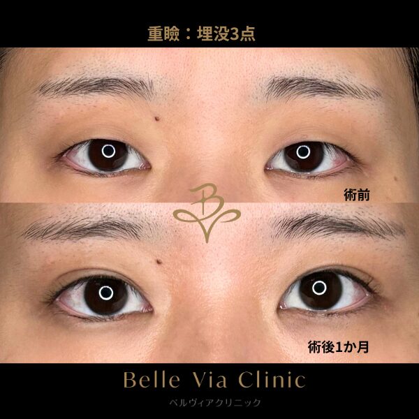 <br />
<b>Warning</b>:  Undefined variable $slide_caption in <b>/home/r5781098/public_html/belleviaclinic.com/wp/wp-content/themes/belle-via-clinic/include/blocks/caseCard.php</b> on line <b>33</b><br />
