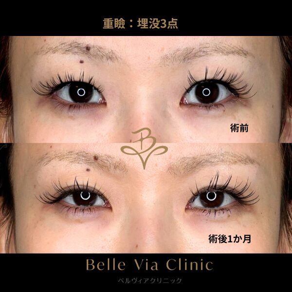 <br />
<b>Warning</b>:  Undefined variable $slide_caption in <b>/home/r5781098/public_html/belleviaclinic.com/wp/wp-content/themes/belle-via-clinic/include/blocks/caseCard.php</b> on line <b>33</b><br />
