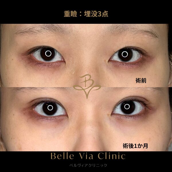 <br />
<b>Warning</b>:  Undefined variable $slide_caption in <b>/home/r5781098/public_html/belleviaclinic.com/wp/wp-content/themes/belle-via-clinic/include/blocks/caseCard.php</b> on line <b>33</b><br />
