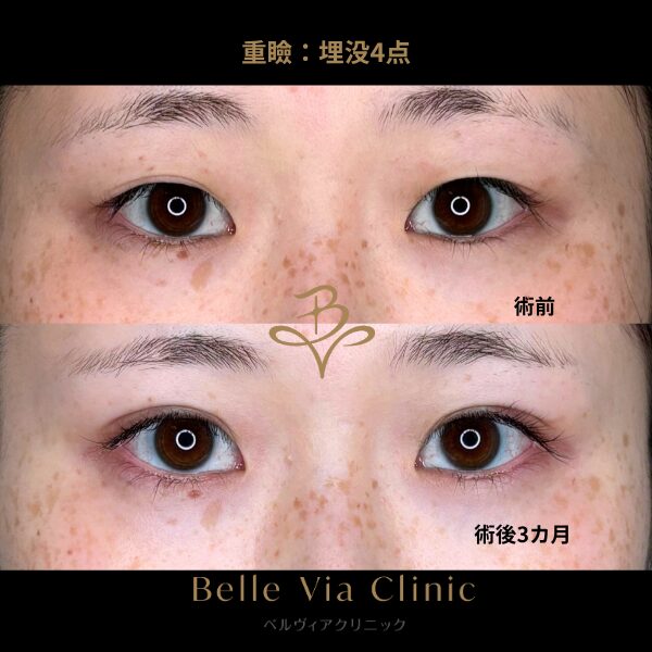 <br />
<b>Warning</b>:  Undefined variable $slide_caption in <b>/home/r5781098/public_html/belleviaclinic.com/wp/wp-content/themes/belle-via-clinic/include/blocks/caseCard.php</b> on line <b>33</b><br />
