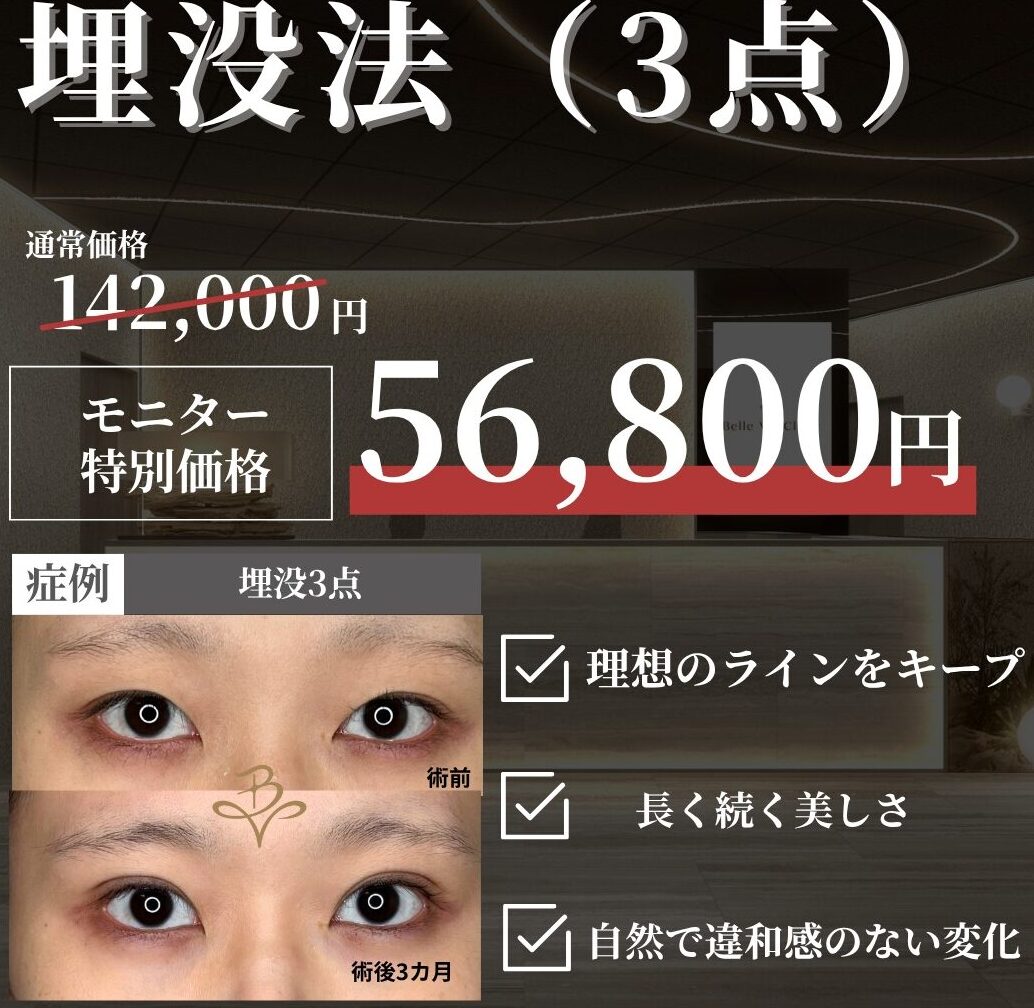 モニター募集／埋没法（3点）