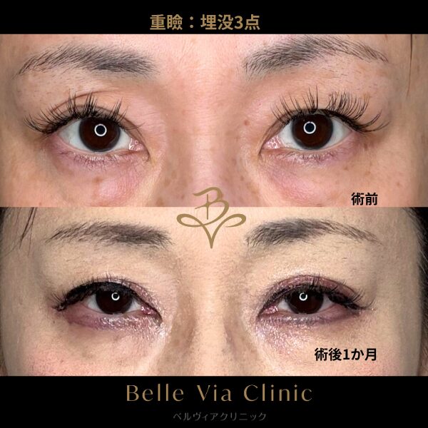 <br />
<b>Warning</b>:  Undefined variable $slide_caption in <b>/home/r5781098/public_html/belleviaclinic.com/wp/wp-content/themes/belle-via-clinic/include/blocks/caseCard.php</b> on line <b>33</b><br />
