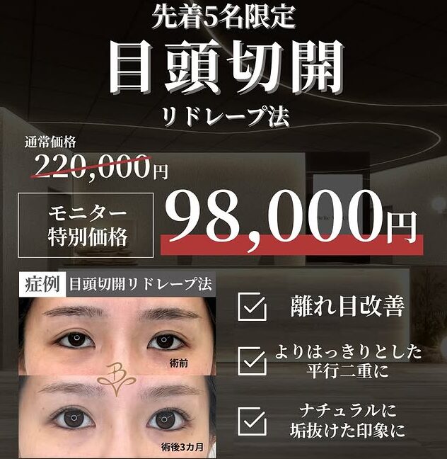 ＼先着5名様限定モニター募集／                   【目頭切開（リドレープ法）】が特別価格で受けられるチャンス！