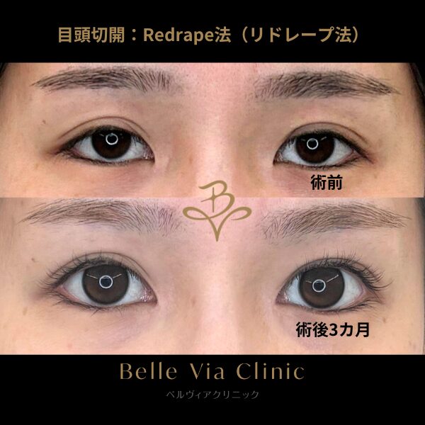 <br />
<b>Warning</b>:  Undefined variable $slide_caption in <b>/home/r5781098/public_html/belleviaclinic.com/wp/wp-content/themes/belle-via-clinic/include/blocks/caseCard.php</b> on line <b>33</b><br />
