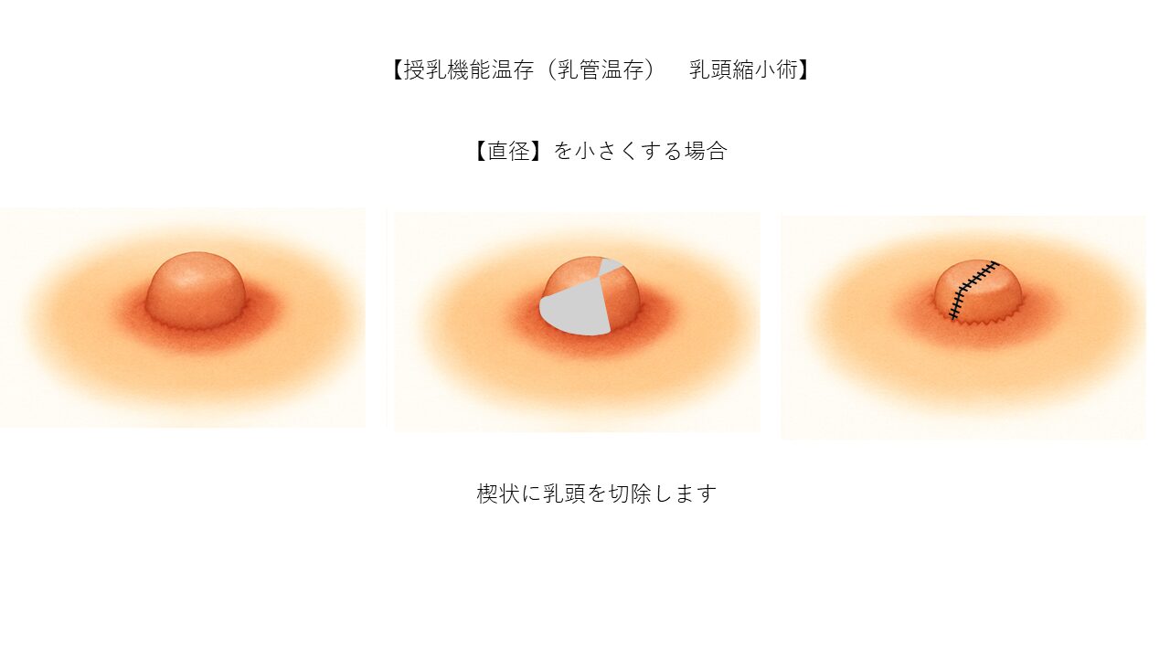 乳頭縮小術の手術手順ステップ2 ベルヴィアクリニック名古屋