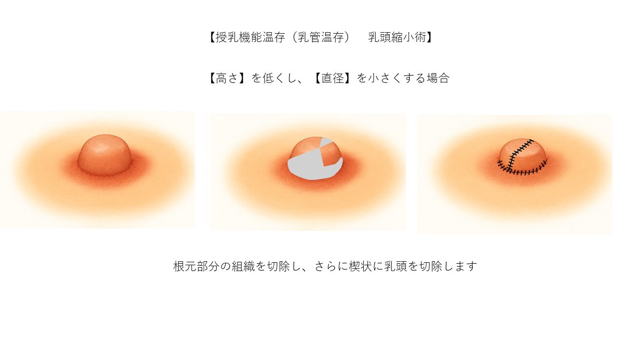 乳頭縮小術の手術手順ステップ3 ベルヴィアクリニック名古屋