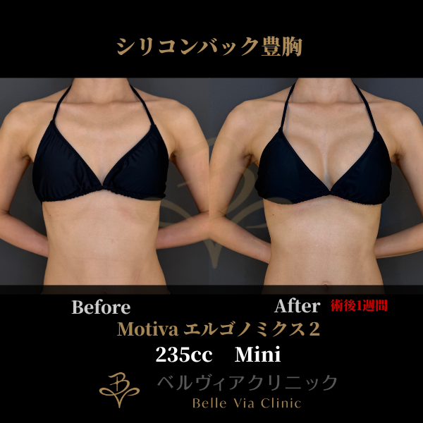 <br />
<b>Warning</b>:  Undefined variable $slide_caption in <b>/home/r5781098/public_html/belleviaclinic.com/wp/wp-content/themes/belle-via-clinic/include/blocks/caseCard.php</b> on line <b>33</b><br />
