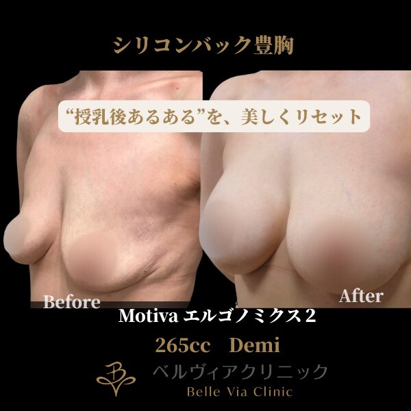 <br />
<b>Warning</b>:  Undefined variable $slide_caption in <b>/home/r5781098/public_html/belleviaclinic.com/wp/wp-content/themes/belle-via-clinic/include/blocks/caseCard.php</b> on line <b>33</b><br />
