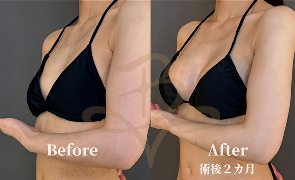 豊胸手術（シリコンバッグ／脂肪注入）