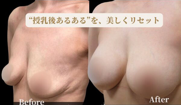 産後ケア：Before / After