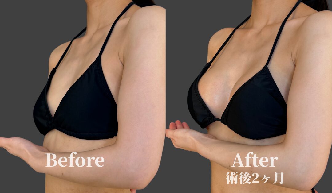 自然なサイズアップ：Before / After