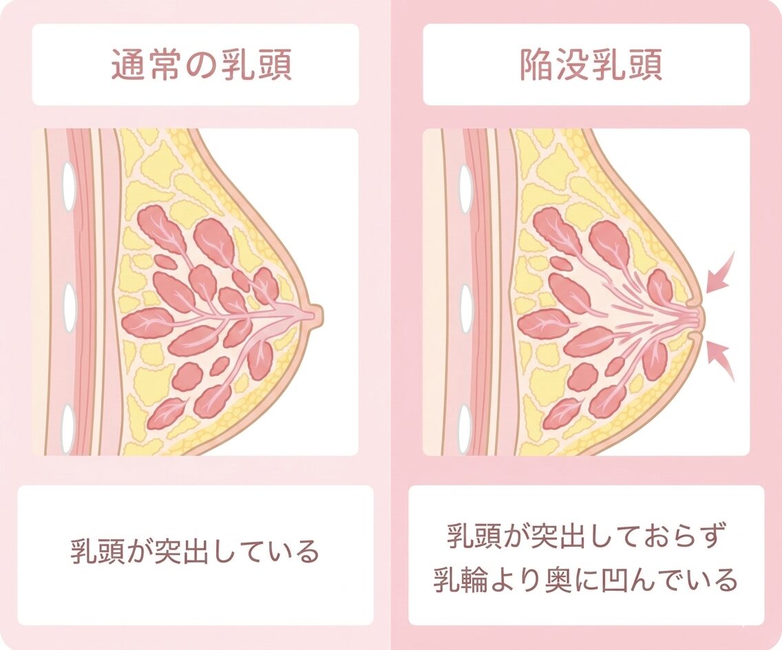 陥没乳頭の原因となる乳管・結合組織の断面図解説 ベルヴィアクリニック名古屋