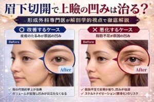名古屋駅（名駅）の形成外科専門医による眉下切開の症例解説画像。上眼瞼の凹み（サンケンアイ）が皮膚のたるみによって生じている改善ケースと、脂肪不足により骸骨化（スケルトナイゼーション）のリスクがある悪化ケースを解剖学的に比較。美容皮膚科ベルヴィアクリニックの専門的な診断。