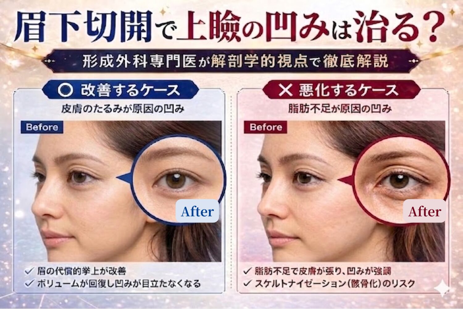 「眉下切開で上瞼の凹みは治る？」形成外科専門医が解剖学的視点で徹底解説