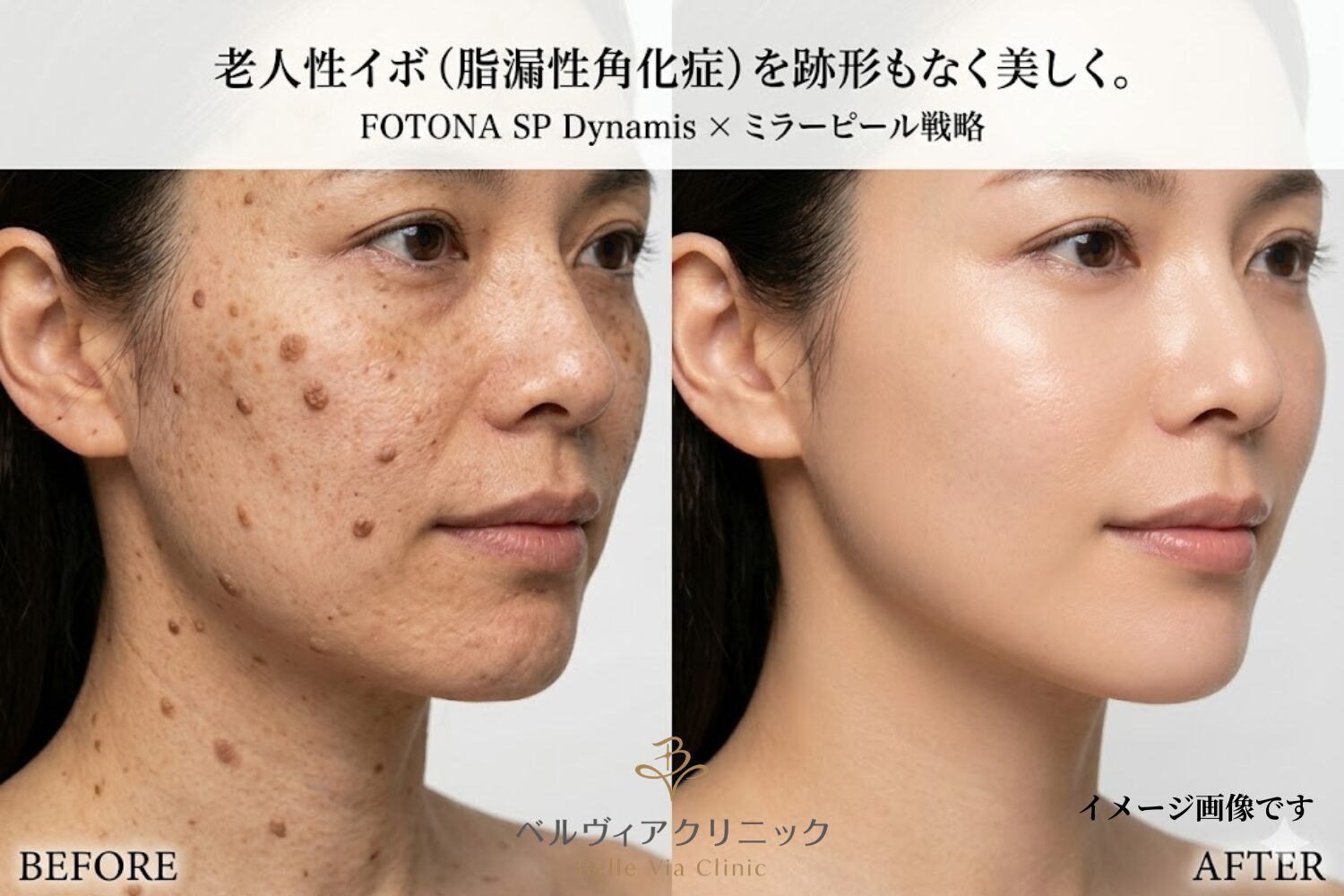 老人性イボ（脂漏性角化症）を跡形もなく美しく。名駅・ベルヴィアクリニックのFOTONA SP Dynamis×ミラーピール戦略