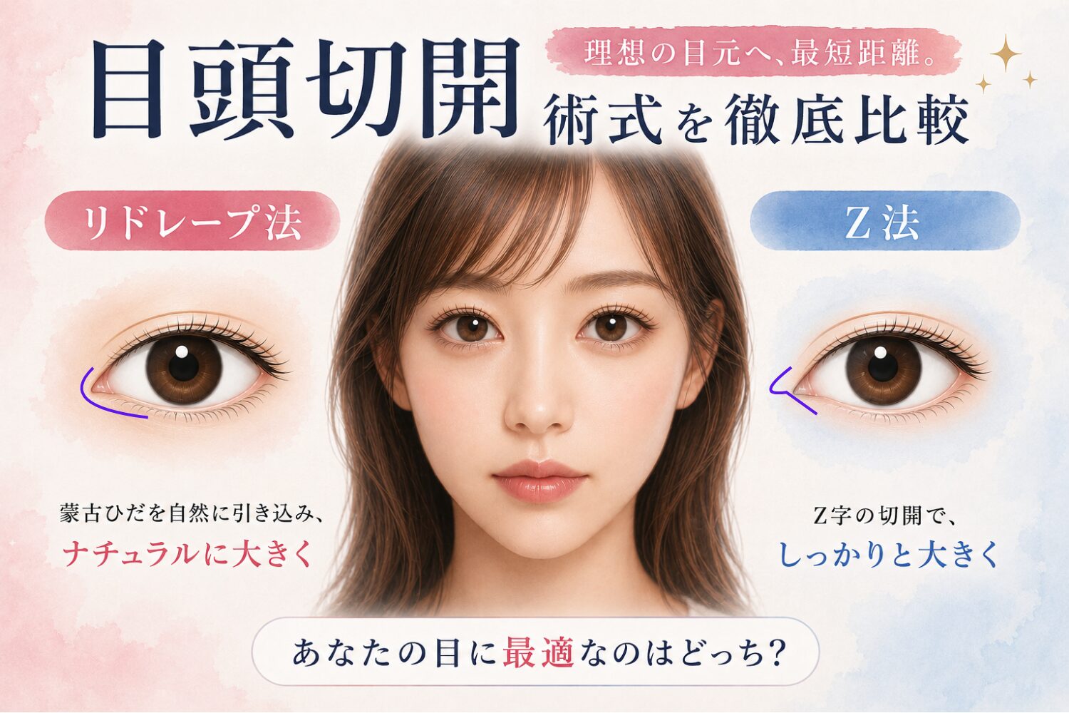 名古屋駅（名駅）エリアの美容皮膚科・形成外科であるBelle Via Clinicが解説する、目頭切開の術式比較画像。女性の顔の正面写真を中心に、左側には蒙古ひだを自然に引き込む「リドレープ法」、右側にはしっかりと目頭を大きくする「Z法」の切開ラインが紫色の線で具体的に描写されており、それぞれの術式の違いを視覚的に説明しています。